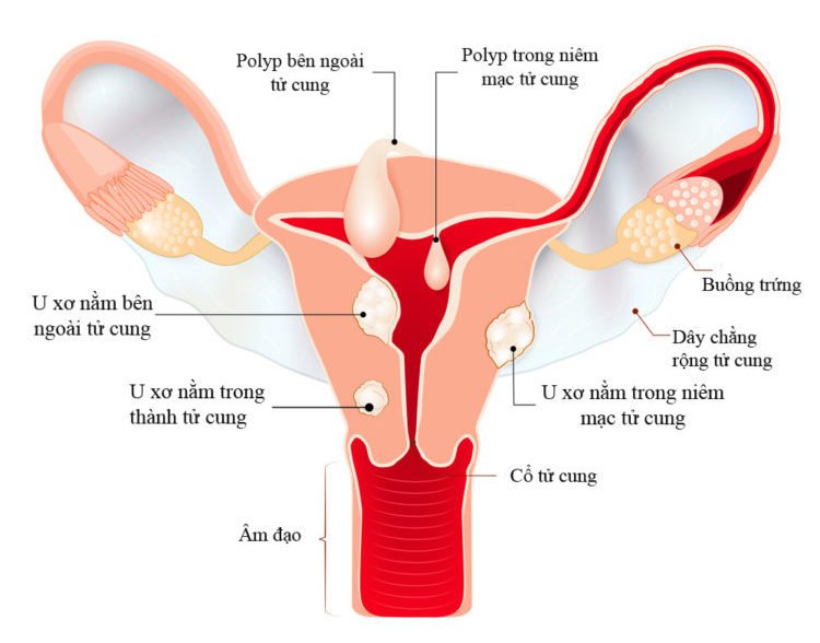 U XƠ TỬ CUNG LÀNH TÍNH HAY ÁC TÍNH?
